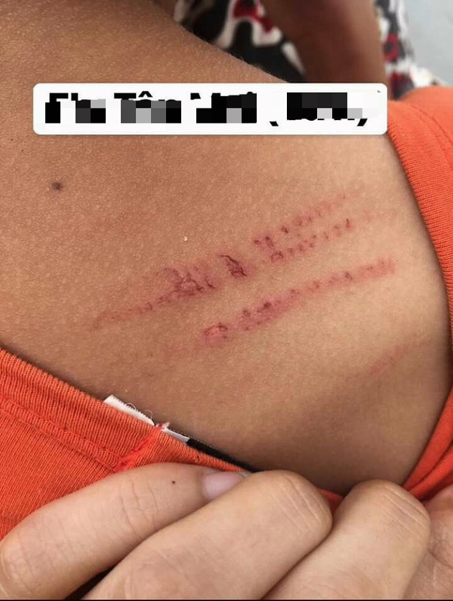 Nghệ An: Nghi án bé trai 12 tuổi bị mẹ kế đánh thương tích đầy mình phải nhập viện