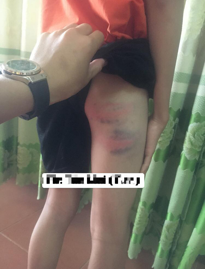 Nghệ An: Nghi án bé trai 12 tuổi bị mẹ kế đánh thương tích đầy mình phải nhập viện