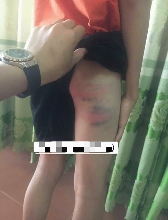 Bé trai 12 tuổi nghi bị mẹ kế đánh nhập viện ở Nghệ An: Mẹ kế là giáo viên, do bé ăn nói hỗn láo nên mới dạy