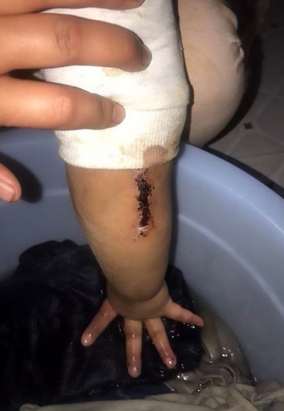 TQ: Bé gái 4 tuổi bị bố đánh bầm tím mắt, lưng bị dí tàn thuốc lá, xích trong nhà vệ sinh