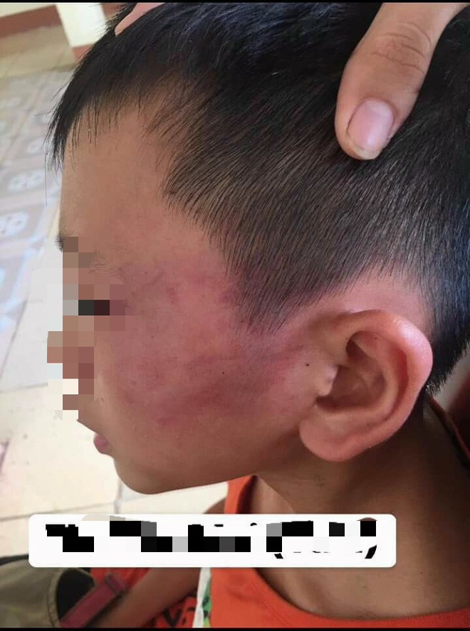 Bé trai 12 tuổi nghi bị mẹ kế đánh nhập viện ở Nghệ An: Mẹ kế là giáo viên, do bé ăn nói hỗn láo nên mới dạy Bé trai 12 tuổi nghi bị mẹ kế đánh nhập viện ở Nghệ An: Mẹ kế là giáo viên, do bé ăn nói hỗn láo nên mới dạy