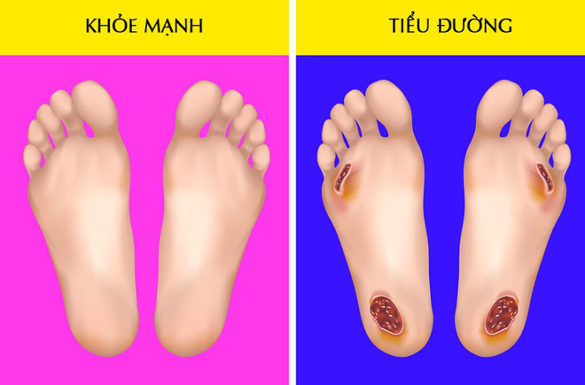 Hãy nhìn xuống đôi chân mình và xem nó đang cảnh báo bạn những vấn đề gì về sức khỏe Hãy nhìn xuống đôi chân mình và xem nó đang cảnh báo bạn những vấn đề gì về sức khỏe