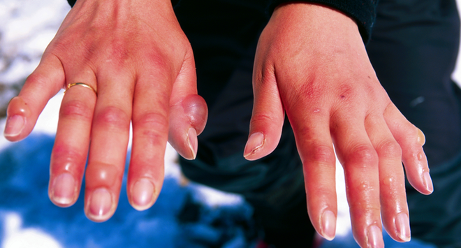 Bỏng lạnh cực nguy hiểm nếu không được sơ cứu đúng cách nhưng mọi người vẫn chưa nâng cao cảnh giác