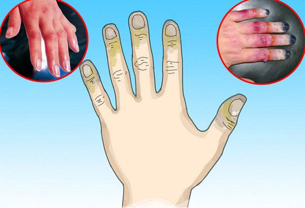 Bỏng lạnh cực nguy hiểm nếu không được sơ cứu đúng cách nhưng mọi người vẫn chưa nâng cao cảnh giác