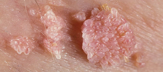 Đắp, bôi tỏi vào vùng kín chữa bệnh, chị em cầu cứu bác sĩ