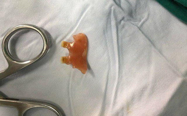 Ho dai dẳng, đi khám viêm phổi mới phát hiện ra thứ kinh khủng mắc kẹt trong phổi