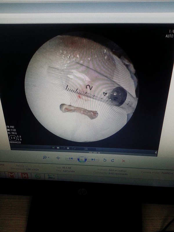 Ho dai dẳng, đi khám viêm phổi mới phát hiện ra thứ kinh khủng mắc kẹt trong phổi