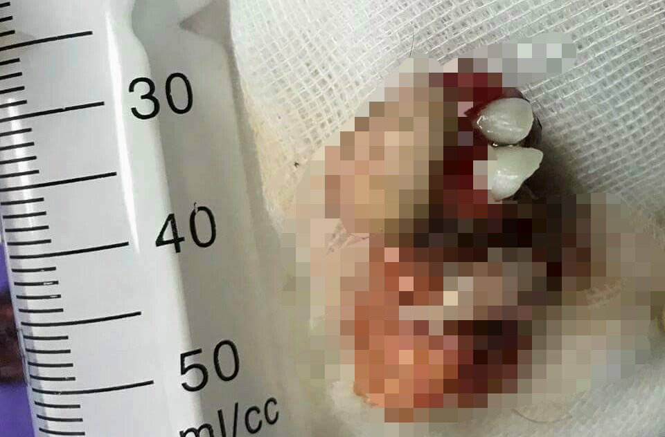 Khối u mọc răng, tóc trong buồng trứng bé gái