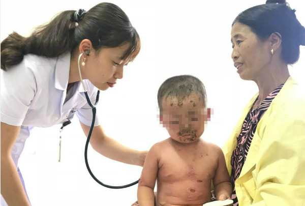 Bé 2 tuổi bị loét mặt do tắm nước lá
