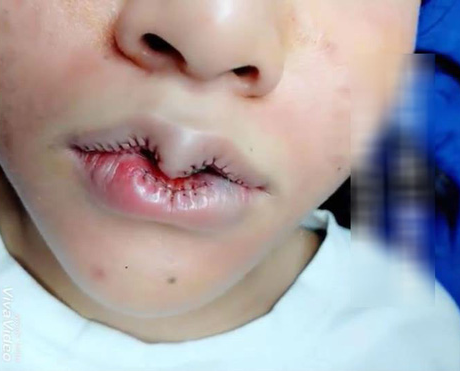 Đôi môi trái tim yêu dấu nổi tiếng nhất MXH đêm qua, chủ spa hạnh phúc khoe thành quả, dân mạng ném đá chẳng khác mỏ chim Đôi môi trái tim yêu dấu nổi tiếng nhất MXH đêm qua, chủ spa hạnh phúc khoe thành quả, dân mạng ném đá chẳng khác mỏ chim