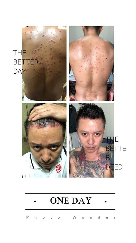 Căn bệnh ca sĩ Tuấn Hưng mắc nguy hiểm như thế nào?