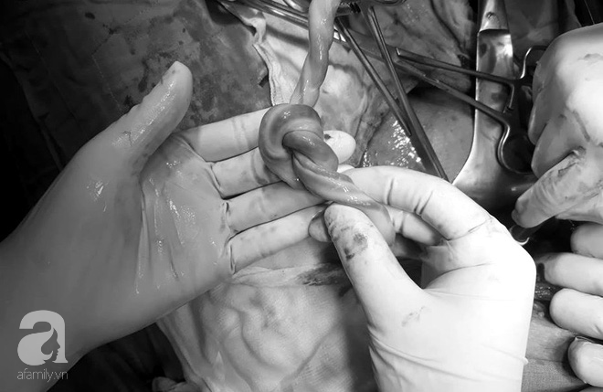 1 giờ cứu sống thai nhi bị dây rốn quấn cổ hiếm gặp ở Cần Thơ