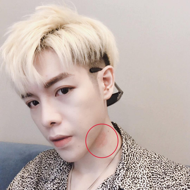 Bị dấu đỏ bất thường nghi là vết tích của người yêu trên cổ, Đức Phúc khóc dở mếu dở giải thích với fan