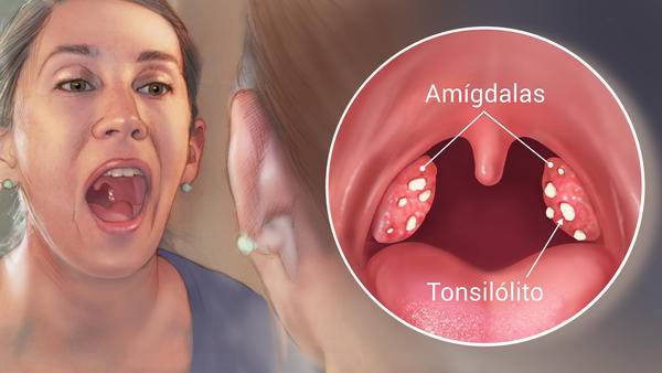 Viêm amidan hốc mủ là bệnh gì? Liệu bạn đã biết rõ Viêm amidan hốc mủ là bệnh gì? Liệu bạn đã biết rõ