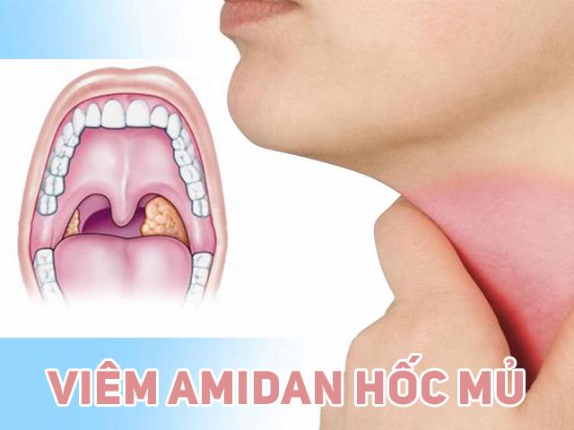 Viêm amidan hốc mủ là bệnh gì? Liệu bạn đã biết rõ Viêm amidan hốc mủ là bệnh gì? Liệu bạn đã biết rõ