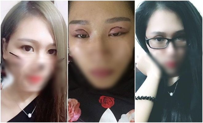 Nghe bạn rủ rê đến spa làm mẫu cắt mí mắt cho rẻ, mẹ trẻ đau đớn khi bỗng dưng lợn lành thành lợn què