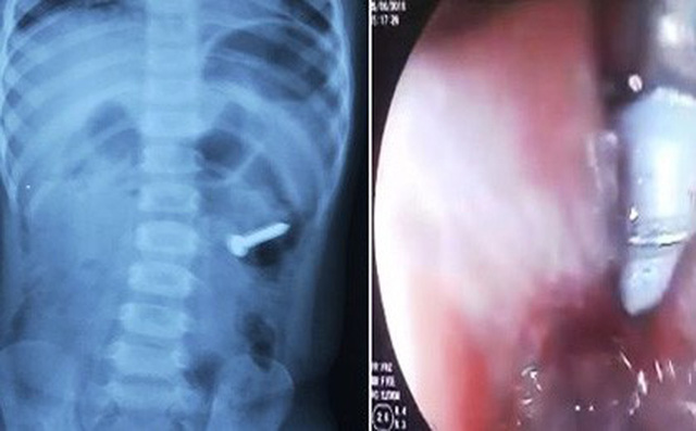 Bé 2 tuổi suýt mất mạng vì nuốt phải đinh ốc xoắn dài 3cm vào bụng Bé 2 tuổi suýt mất mạng vì nuốt phải đinh ốc xoắn dài 3cm vào bụng