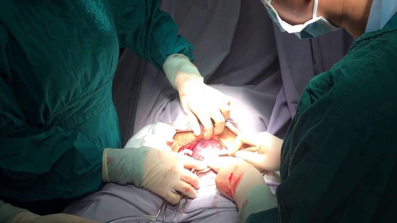 Thai 4,4kg được chỉ định mổ đẻ, mẹ bầu Hải Phòng quyết chờ ngày đẹp và cái kết đau đớn