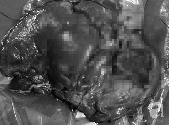 Bé gái 2 tuổi người Việt mang khối u ác tính ở gan cực hiếm gặp trên thế giới