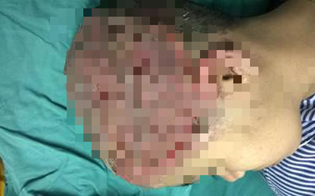 Thiếu nữ 17 tuổi bị hoại tử toàn bộ da đầu vì uốn tóc mừng sinh nhật