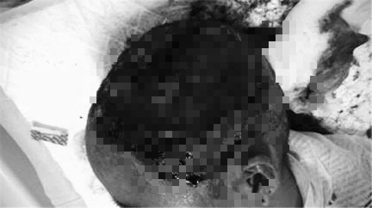 Thiếu nữ 17 tuổi bị hoại tử toàn bộ da đầu vì uốn tóc mừng sinh nhật