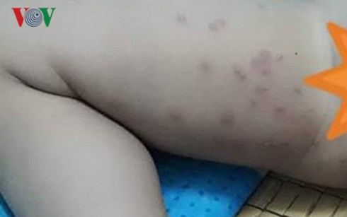 Du khách tắm biển Đà Nẵng bị ngứa ngáy, nổi mẩn đỏ khắp người