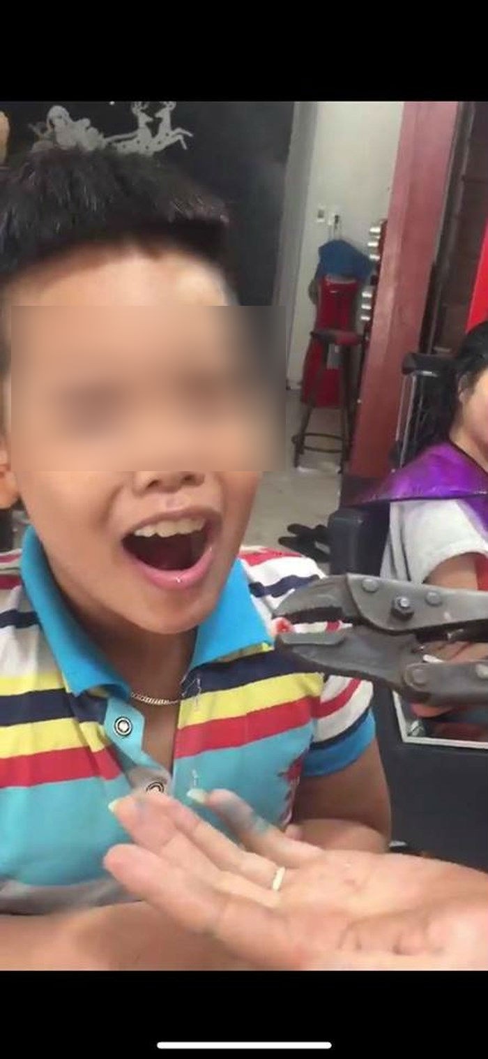 Ông bố bị dân mạng chỉ trích gay gắt khi dùng kìm cộng lực nhổ răng cho con ở nhà