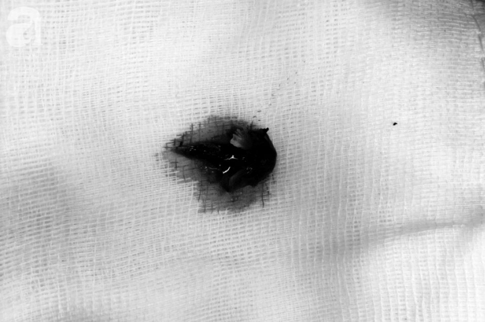 Hóc xương cá nhưng không điều trị dứt điểm, 5 năm sau người đàn ông phải cắt bỏ nửa lá phổi