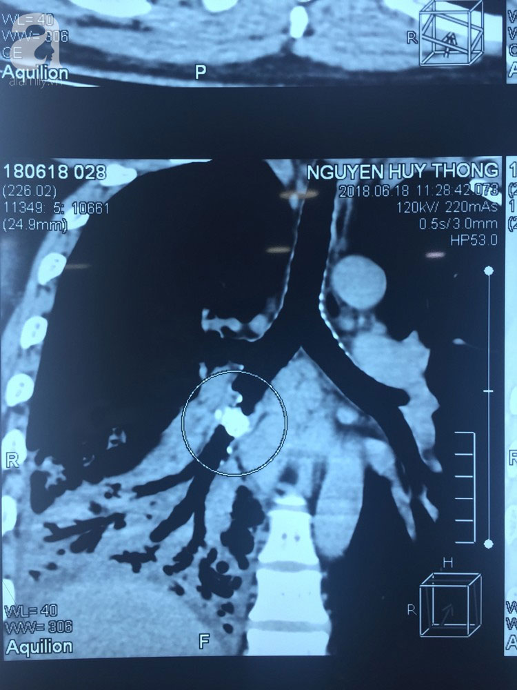 Hóc xương cá nhưng không điều trị dứt điểm, 5 năm sau người đàn ông phải cắt bỏ nửa lá phổi