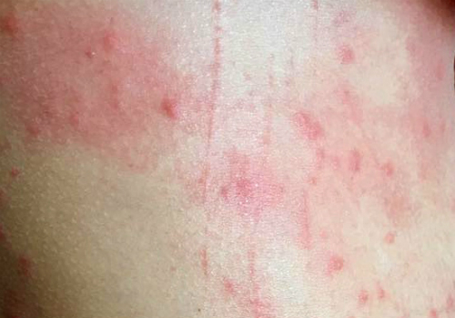 Đà Nẵng: Sứa lửa có thể khiến người dân nổi mẩn đỏ khi tắm biển