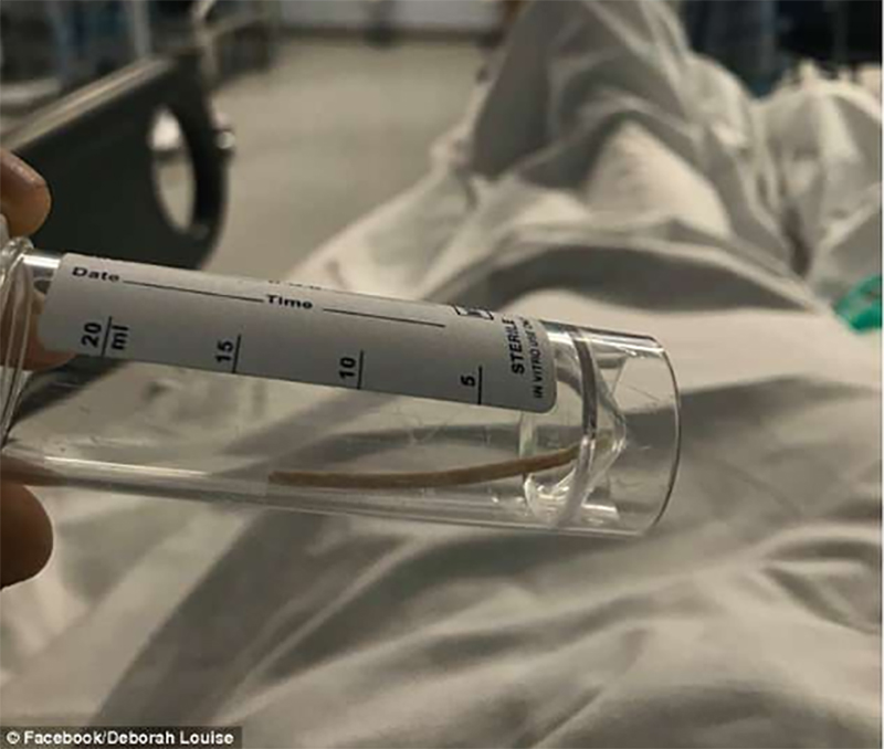 Que tránh thai đi lạc tới tim, kẹt trong động mạch phổi suốt 2 năm