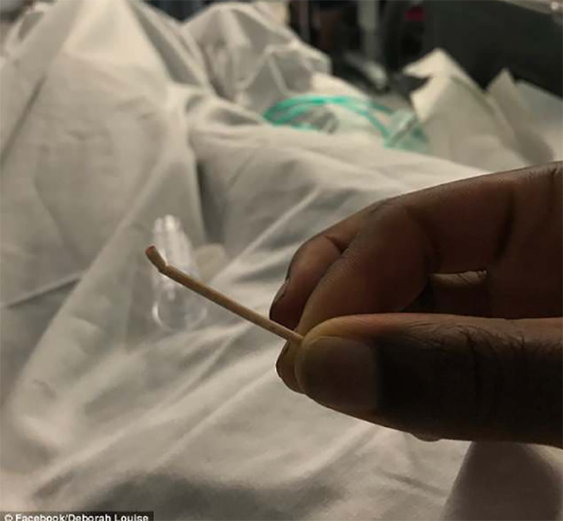 Que tránh thai đi lạc tới tim, kẹt trong động mạch phổi suốt 2 năm