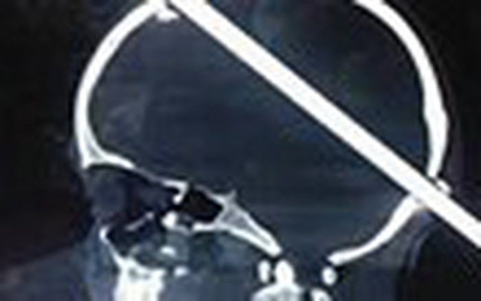 Cứu sống bé trai bị thanh sắt đâm thủng hộp sọ