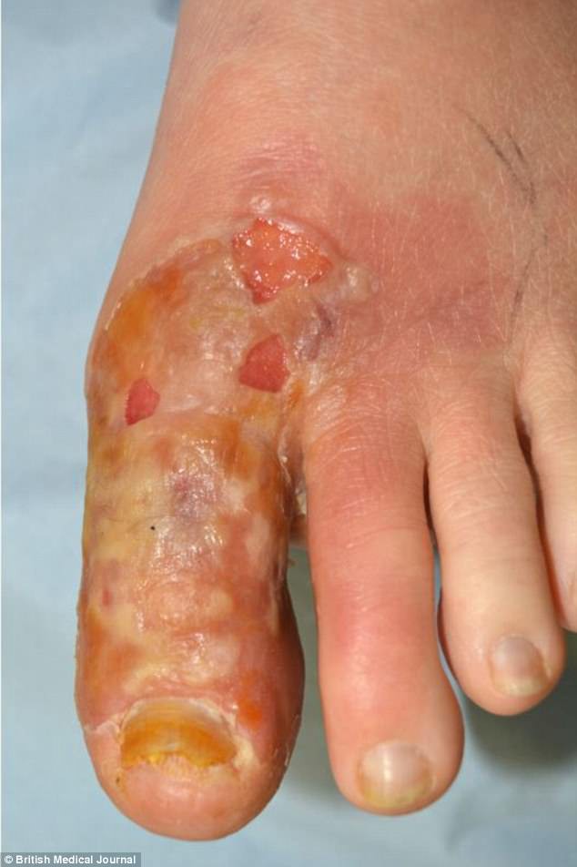 Điều trị nấm móng bằng cách đắp tỏi tươi, người phụ nữ 45 tuổi bị bỏng cấp độ 2