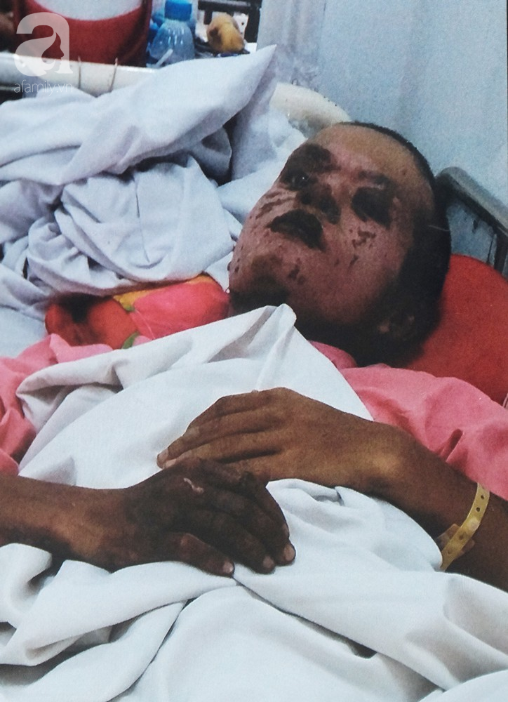 TP.HCM: Thương tâm cảnh thai phụ trẻ và người yêu bỏng nặng vì cháy nhà trước ngày cưới