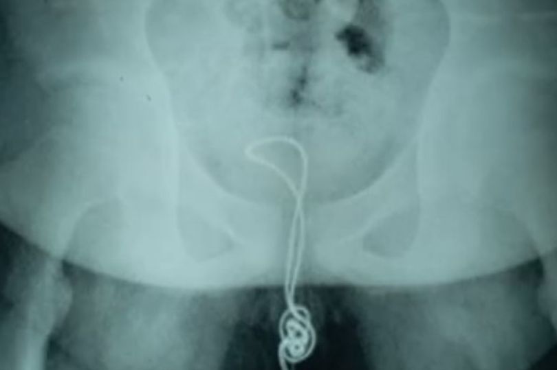 Dây sạc điện thoại mắc kẹt trong của quý thiếu niên TQ