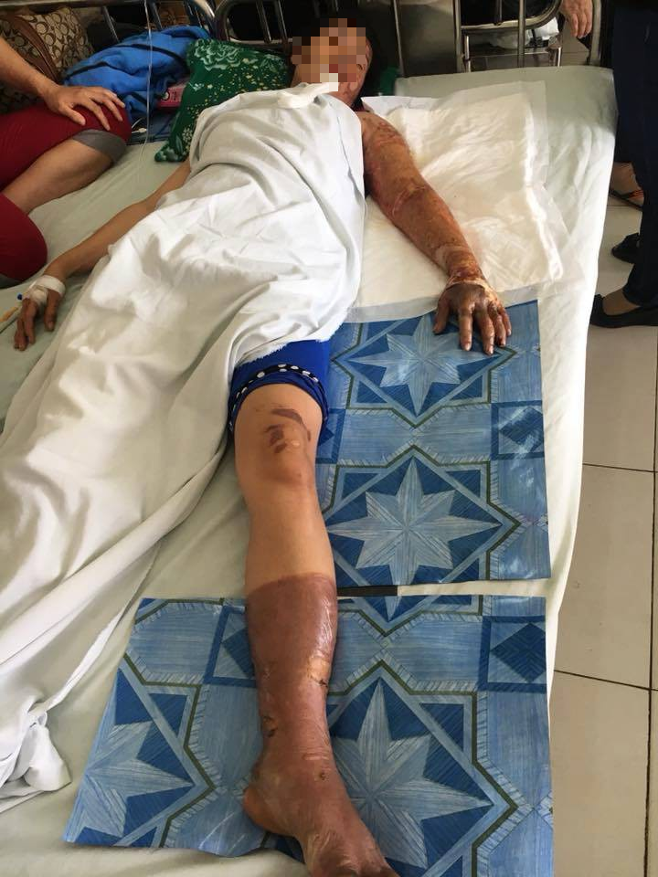 Đồng Tháp: Bị người tình phát hiện có vợ con nên đòi chia tay, gã đàn ông mua xăng về phóng hỏa khiến 3 người nhập viện