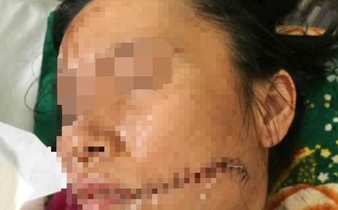 Rạch mặt người tình rồi tưới xăng thiêu sống để chết chung