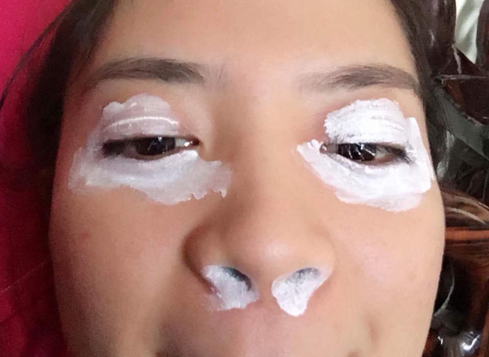 Mùa kiến ba khoang lại đến, dân mạng kêu trời vì bị đốt để rồi phải trang điểm bằng thuốc đặc trị