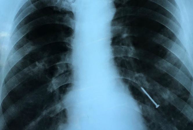 Người đàn ông bất ngờ bị đinh văng qua miệng xuống phổi