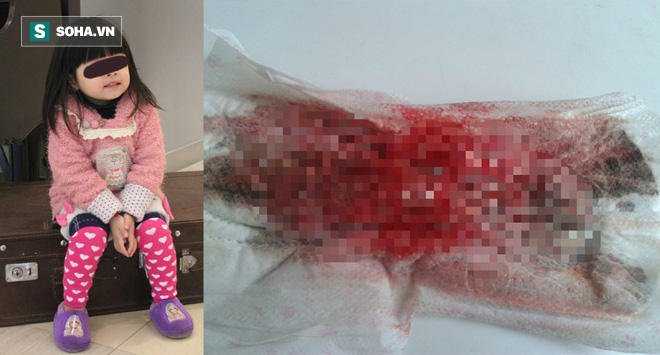 Bé gái 4 tuổi xuất hiện kinh nguyệt, cảnh báo tình trạng trẻ dậy thì sớm đang gia tăng