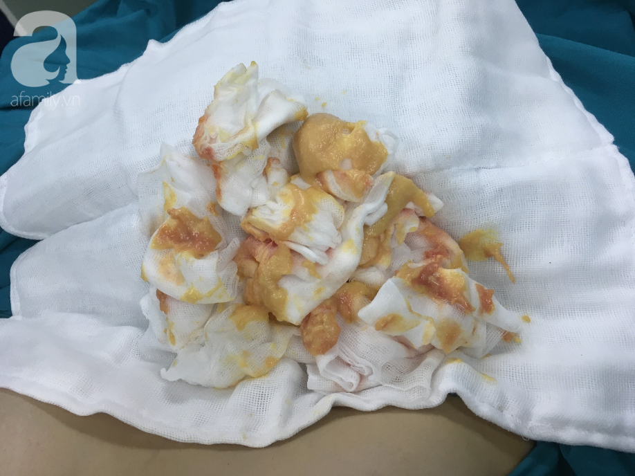 Sang Thái Lan bơm mỡ nhân tạo, nữ Việt kiều bị hoại tử ngực nặng