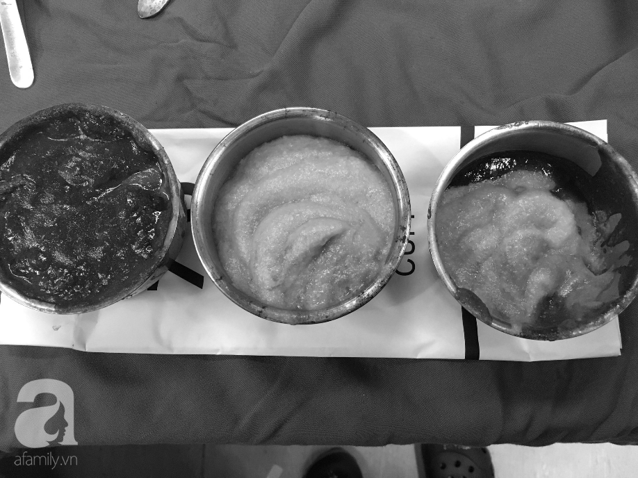 Sang Thái Lan bơm mỡ nhân tạo, nữ Việt kiều bị hoại tử ngực nặng