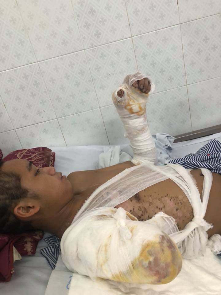 Bố chết mẹ bỏ đi biền biệt, chàng trai đang một mình nuôi 5 em nhỏ bỗng bị điện giật cụt tay, sống lay lắt