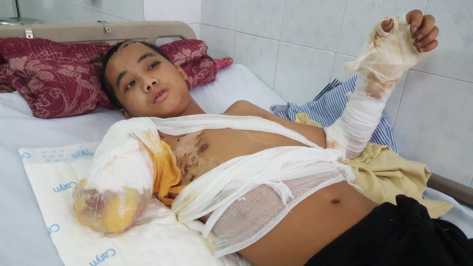 Bố chết mẹ bỏ đi biền biệt, chàng trai đang một mình nuôi 5 em nhỏ bỗng bị điện giật cụt tay, sống lay lắt