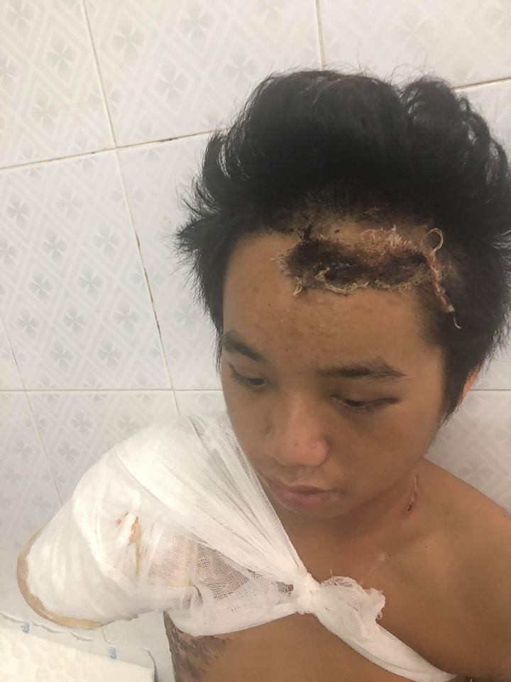 Bố chết mẹ bỏ đi biền biệt, chàng trai đang một mình nuôi 5 em nhỏ bỗng bị điện giật cụt tay, sống lay lắt