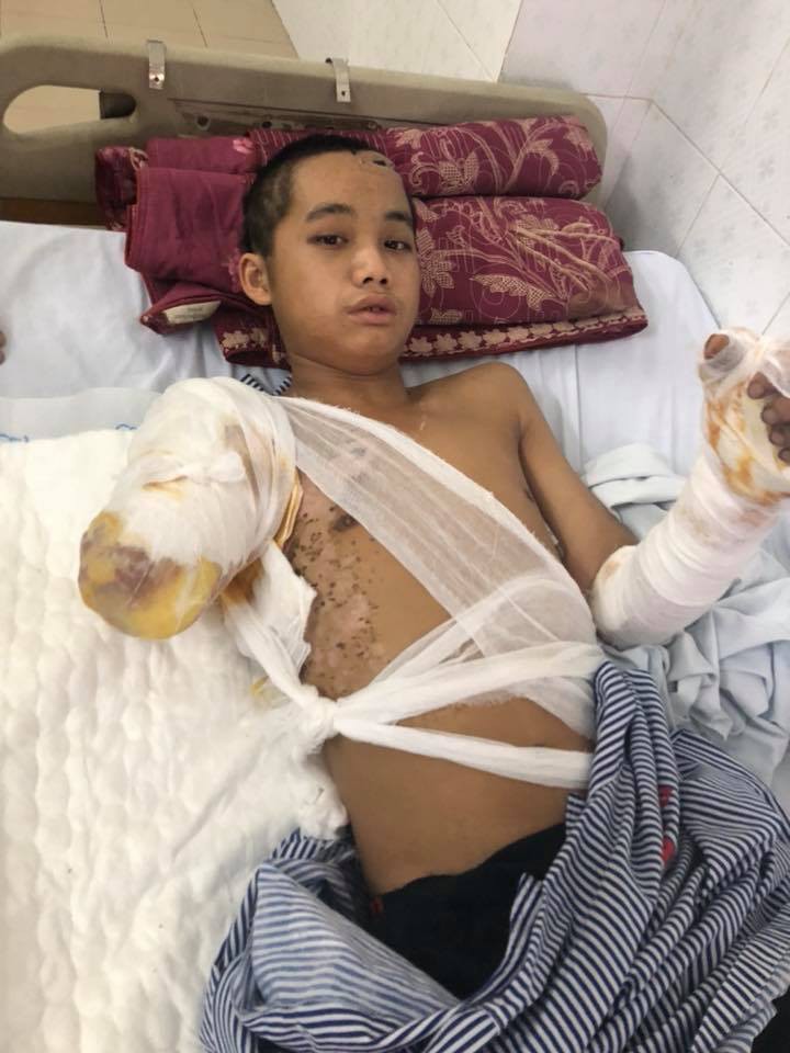 Bố chết mẹ bỏ đi biền biệt, chàng trai đang một mình nuôi 5 em nhỏ bỗng bị điện giật cụt tay, sống lay lắt