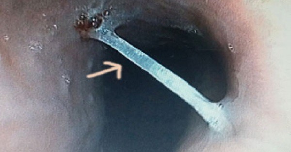 Đây là cách xử lý khi bị hóc xương cá, tránh những hậu quả không mong muốn Đây là cách xử lý khi bị hóc xương cá, tránh những hậu quả không mong muốn