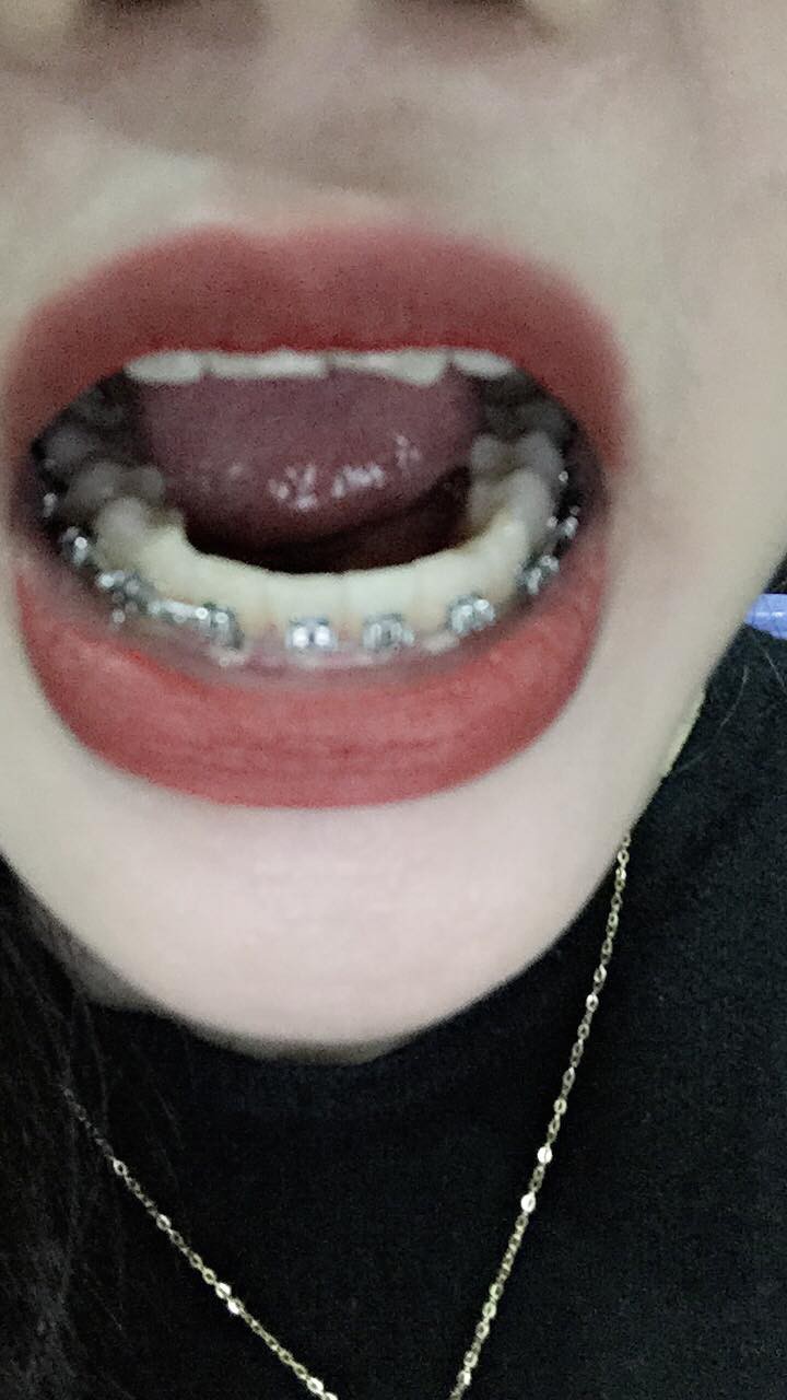 Bị chồng cũ chê răng thò thụt mất trật tự, ly hôn xong mẹ trẻ bỏ 40 triệu đi niềng răng, vô tình lột xác đến ngỡ ngàng