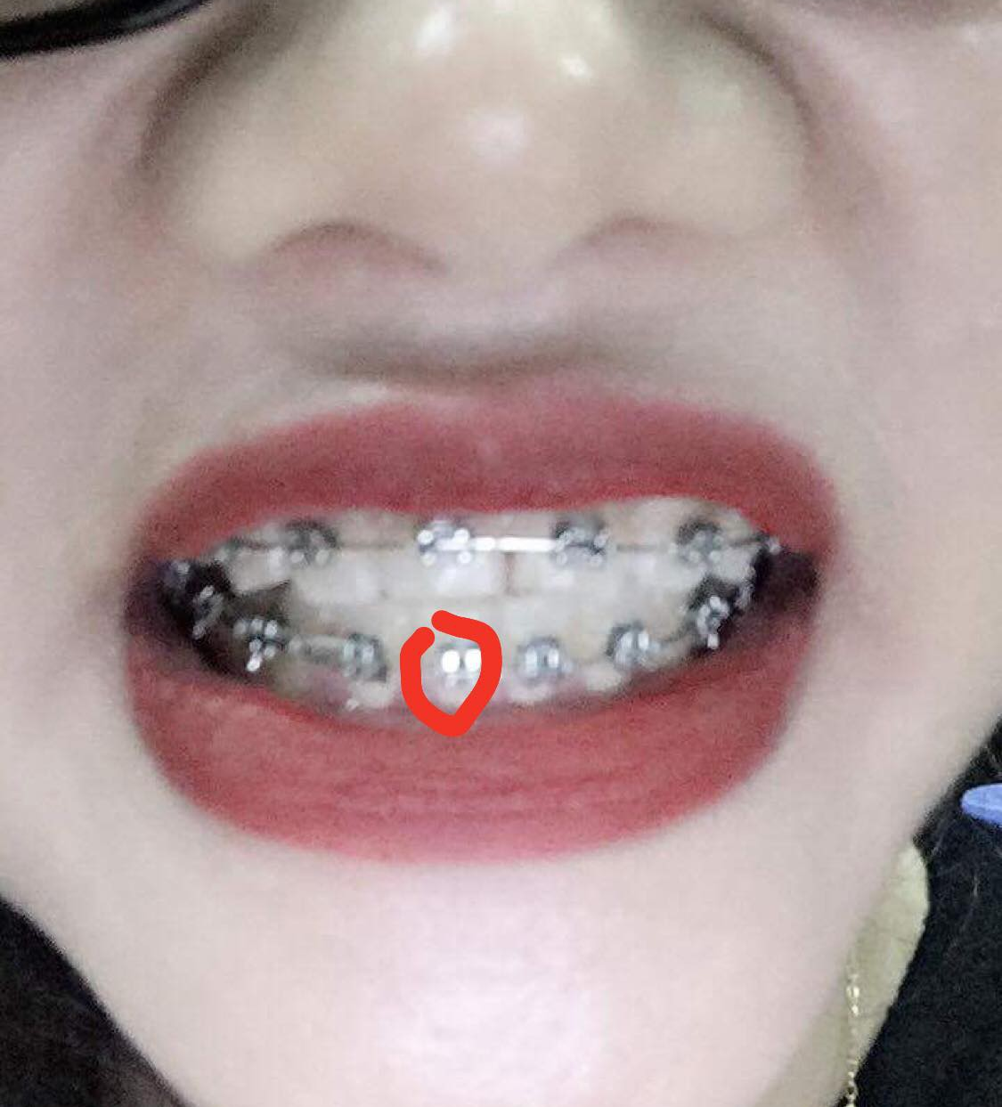 Bị chồng cũ chê răng thò thụt mất trật tự, ly hôn xong mẹ trẻ bỏ 40 triệu đi niềng răng, vô tình lột xác đến ngỡ ngàng